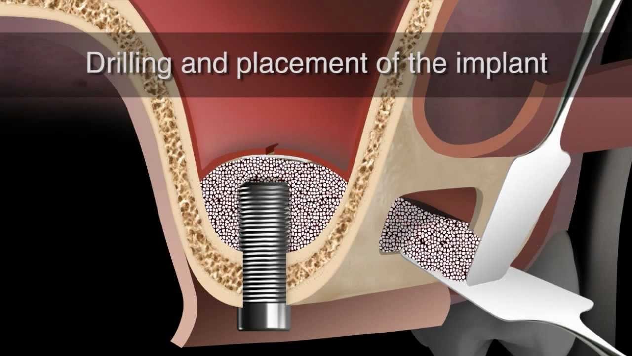 Sinus Lifting | APEKS Ağız Ve Diş Sağlığı Polikliniği
